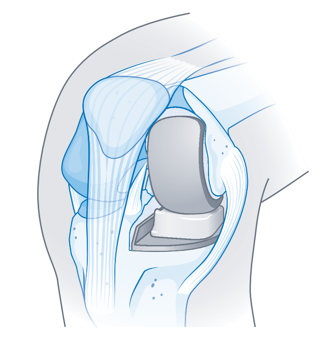 Illustration und eine Röntgenaufnahme einer Schlittenprothese für eine Kniegelenk im Albertinen Endoprothetikzentrum Hamburg Illustration und eine Röntgenaufnahme einer Schlittenprothese für eine Kniegelenk im Albertinen Endoprothetikzentrum Hamburg