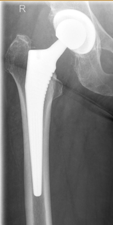 Röntgenaufnahme einer Standardprothese für ein Hüftgelenk im Albertinen Endoprothetikzentrum in Hamburg Röntgenaufnahme einer Standardprothese für ein Hüftgelenk im Albertinen Endoprothetikzentrum in Hamburg