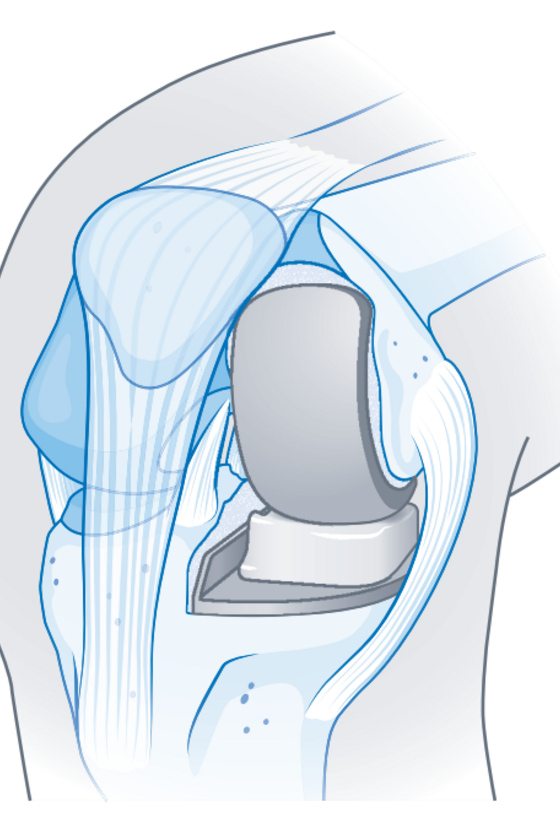 Illustration einer Schlittenprothese für ein künstliches Kniegelenk aus dem Leistungsspektrum im Albertinen Endoprothetikzentrum Hamburg