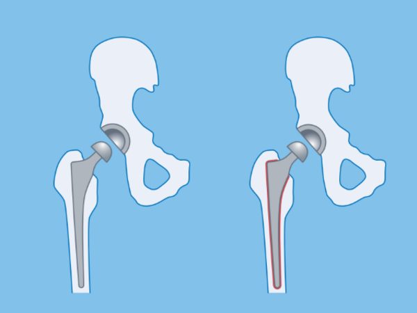 Grafische Darstellung von Kurzschaftprothesen in vollzementierter, zementfreier und teilzementierter Ausführung für ein künstliches Hüftgelenk aus dem Leistungsspektrum im Albertinen Endoprothetikzentrum in Hamburg