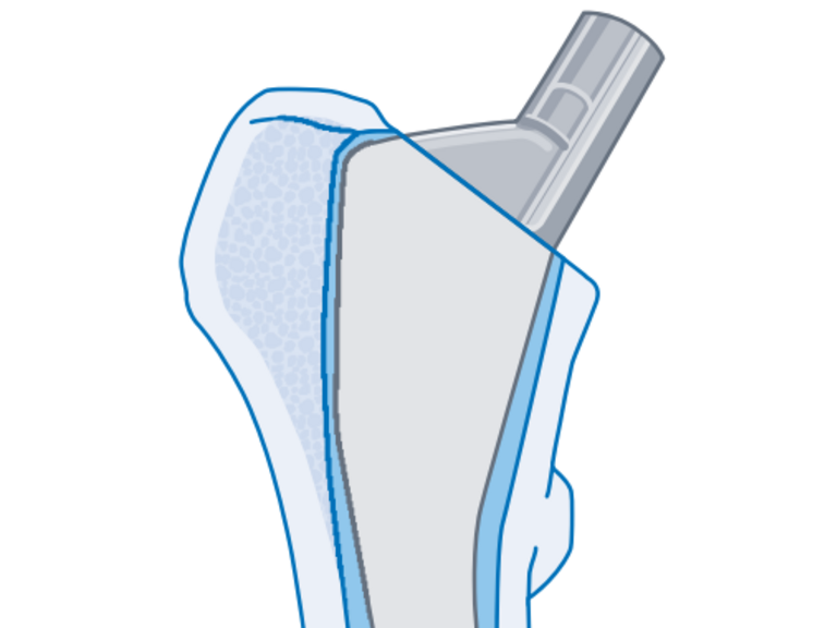 Grafische Darstellung einer vollzementierten Kurzschaftprothese für ein künstliches Hüftgelenk aus dem Leistungsspektrum im Albertinen Endoprothetikzentrum in Hamburg 
