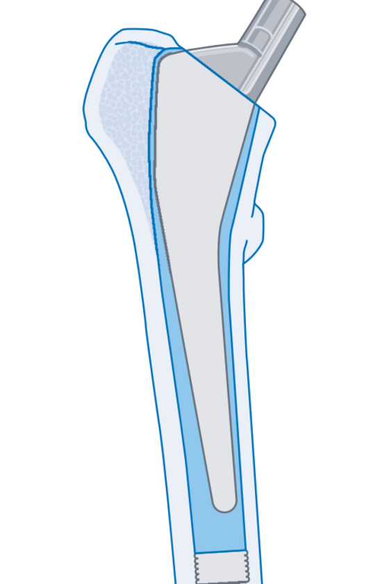 Grafische Darstellung einer vollzementierten Kurzschaftprothese für ein künstliches Hüftgelenk aus dem Leistungsspektrum im Albertinen Endoprothetikzentrum in Hamburg 