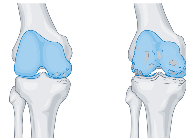 Grafische Darstellung eines Kniegelenks mit Prothesenteil mit Knorpelschäden und verengtem Gelenkspalt im Albertinen Endoprothetikzentrum Hamburg